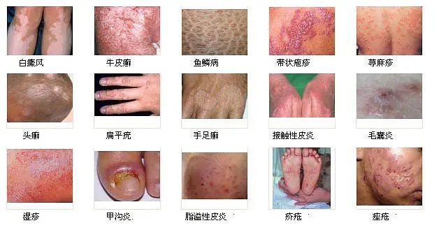 皮肤病fw658