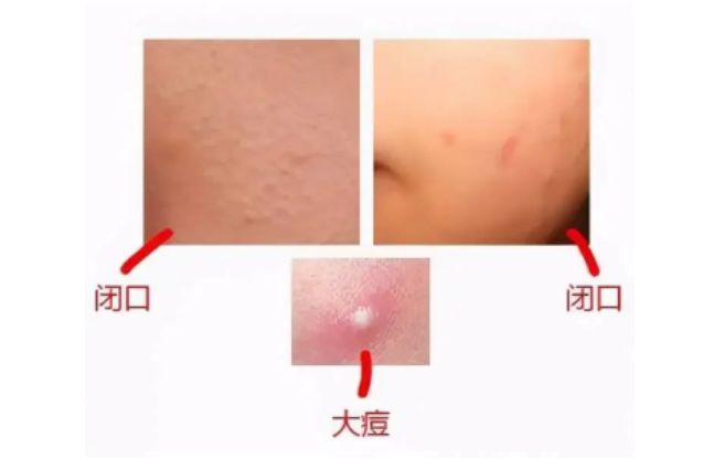 闭口